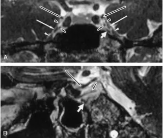 TABLE 2: Detectability of cavernous segments of cranial nerves in40 normal cavernous sinuses on enhanced imaging