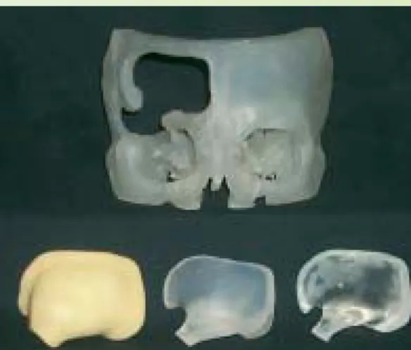 Figure 9 The SLA model together with the template and the implant 3