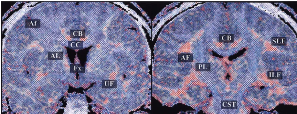 FIG 3.2D visualization of coronal sections of a DT imaging. The major eigenvector of each voxel is displayed with line (in-planecomponent of the eigenvector) and color (from green to red, out-of-plane component of the eigenvector) on the background image o