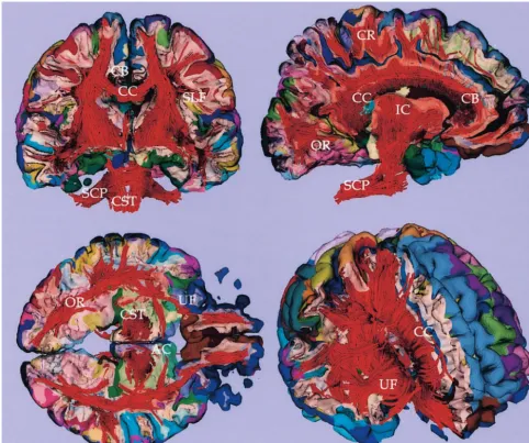 FIG 7.Fiber tractography combined with cortical parcellation. Coronal, sagittal, and axial cross-sectional views of white and graymatter surface combined with fiber tractography are visualized