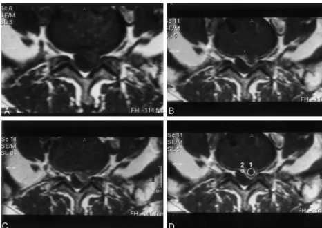 TABLE 1: Contrast enhancement in recurrent disk fragment and scar after IV injection of ionic and nonionic contrast media
