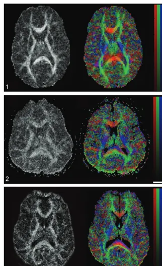 FIG 1.Axial FA map (left) and colorcoded map of mean diffusion direction(right) at the level of the basal ganglia,thalami and internal capsulae in a healthycontrol subject