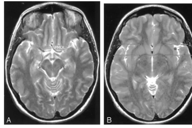 TABLE 5: Display of orbitofrontal and insular anatomy on axial MR images
