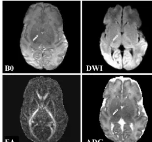 TABLE 2: Neurologic outcome and conventional MR imagingcategory for 63 infants fully studied