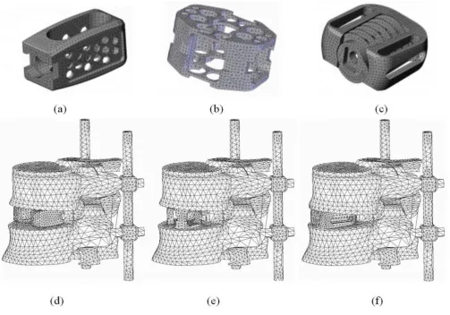 Figure 1each inserted in the L4–L5 motion segment supplemented with posterior instrumentationsFinite element models of three interbody cages: (a) dual paralleled cage; (b) single large cage; (c) two-part cage, and (d, e, f) Finite element models of three interbody cages: (a) dual paralleled cage; (b) single large cage; (c) two-part cage, and (d, 