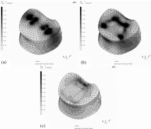 Figure 3leled cage; (b) single large cage; (c) two-part cageThe maximum von Mises stress distribution on the L5 upper endplate after insertion of various interbody cages: (a) dual paral-The maximum von Mises stress distribution on the L5 upper endplate after insertion of various interbody cages: (a) dual paralleled cage; (b) single large cage; (c) two-part cage.