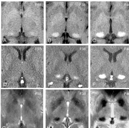 FIG 3.Comparison of CT and MR findings in the posterior thalamus.A–C, T1-weighted images through the thalamus in three patients with mild (A), moderate (B), and marked (C) hyperintensity,respectively.D–F, Corresponding CT scans demonstrate increased attenu