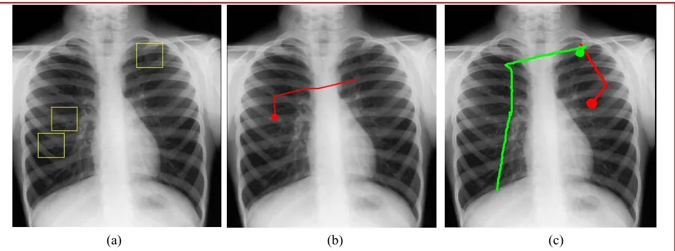 Fig. 1. a) Chest x-ray with three pulmonary nodules highlighted. b) 500ms of pre-recorded eye movement taken from an experienced radiologist as they searched for nodules