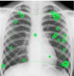 Figure 5. An example of the nodule ROI and wavelet feature vector related to that sub-image