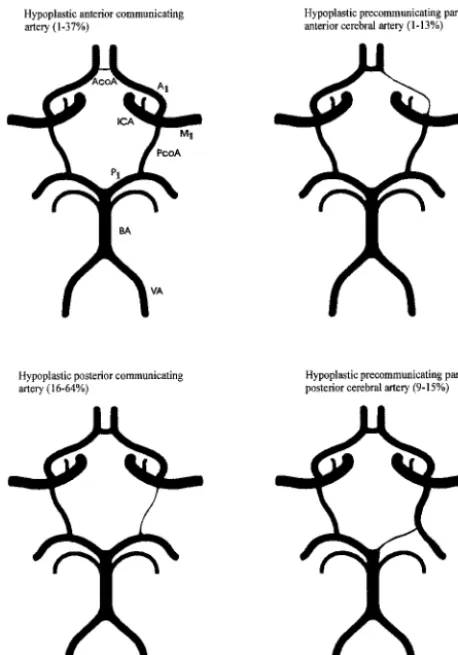 TABLE 1: MR angiography compared with conventional angiographyfor the detection of intracranial collaterals
