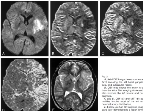 FIG 3.A, Axial DW image demonstrates an in-