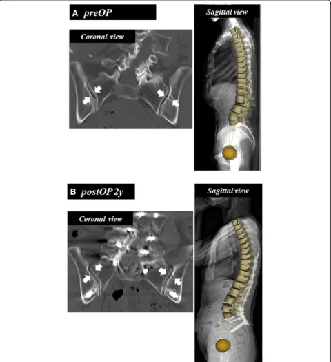 Fig. 5 Reconstructive coronal reconstructed CT images of bilateral sacro-iliac joints and corresponding EOS images of the patient (Figs.a 2 and 4)