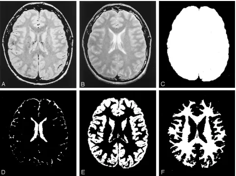 FIG 1. Segmented images from one section based on various MR images. The normalized volume measure is tissue volume (E or F)relative to the total intracranial volume (C).A, Original dual-echo FSE proton density–weighted image.