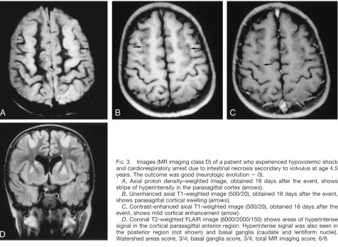 TABLE 3: Findings at first MR imaging and neurologic evolution
