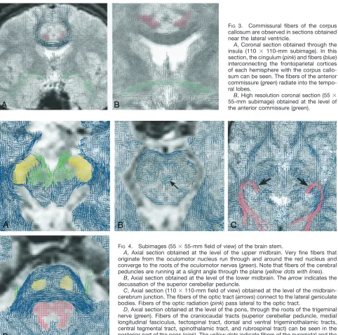 FIG 3.Commissural fibers of the corpuscallosum are observed in sections obtainednear the lateral ventricle.A, Coronal section obtained through the
