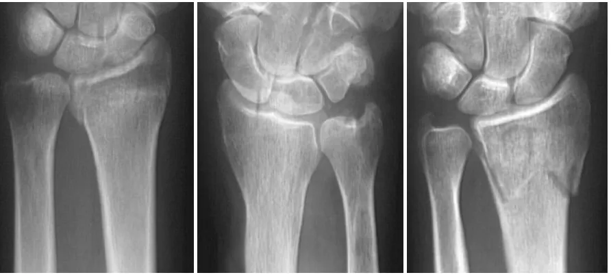 Figure 1: Three of the images from the test bank demonstrating the fracture appearances from subtle to obvious