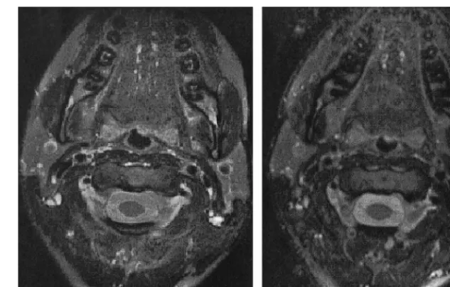 FIG 6.Comparison of corrected FSE MRimages obtained with the head and neckphased array coil.A, 2D images (256 � 256 matrix, 4-mm