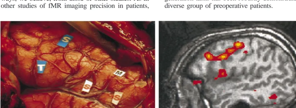 TABLE 6: Brodmann area of speech function in patients under-going both ECS and fMR imaging