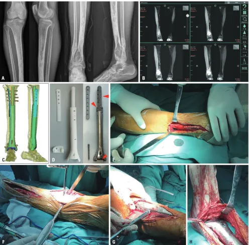 Fig. 1. Preoperative examination, design, and construction of the prosthesis using three-dimensional (3D)-printing technology