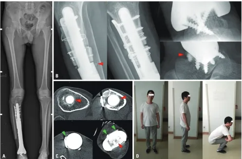 Fig. 2. Postoperative review. (A) Good prosthesis position and lower limb force line in full-length radiography images at 3 months after the operation