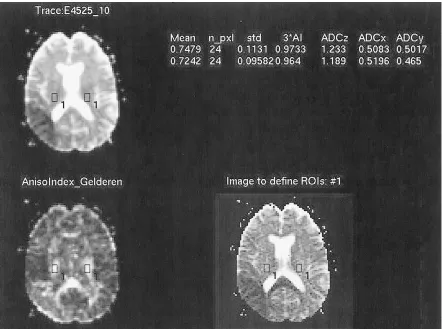 TABLE 1: Relationship between the degree of hemiparesis and thetype of pathologic abnormality