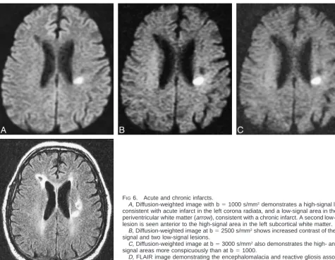 Figure 1 demonstrates the change in signal �tween three tissue types: a) normal gray matter tissue (assumedapparent diffusion coefﬁcient [ADC]S1 � S0� be- 0.8 10–3 mm2/s,