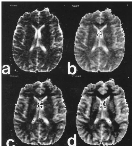 FIG 5.Reversal of gray-white matter contrast with increasing bvalues. Relative signal intensity values obtained from equation 2in the text.
