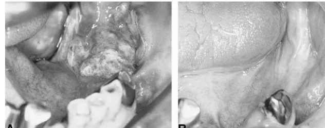 FIG 4.64-year-old man with gingival can-cer (T2N0M0, stage II). The tumor in thelower gingiva of the molar region disap-peared after treatment.A, Before treatment.