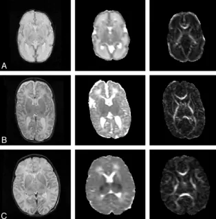 FIG 1. Anatomic, MD, and FA map of a neonate. A, At 30 weeks’ gestational age; B, at term age; andC, after perinatal asphyxia scanned on day 4, with abnormal low signal intensity in the central graymatter on the MD map