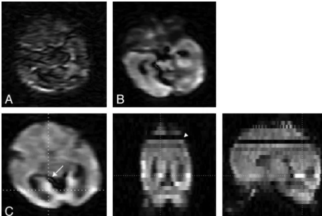 FIG 2. Effects of motion and pulsation. A, Almost complete signal loss caused by head motion; B,signal drop-out caused by pulsation; and C, 3-plane view in which the effects of pulsation (arrow)and motion (arrowhead) are visible.