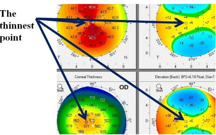 Fig.8; and the value of them was compared. If the values for the thinnest points were within the normal range that the ophthalmologist agreed on, then the 