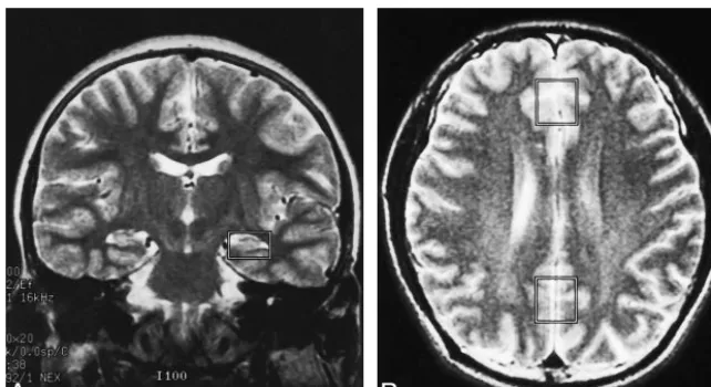 FIG 1.A and B, Coronal (A) and axial (B)T2-weighted MR images show typical lo-cations selected for proton MR spectros-copy of the allocortex (A), parietal cortex,and frontal cortex (B).