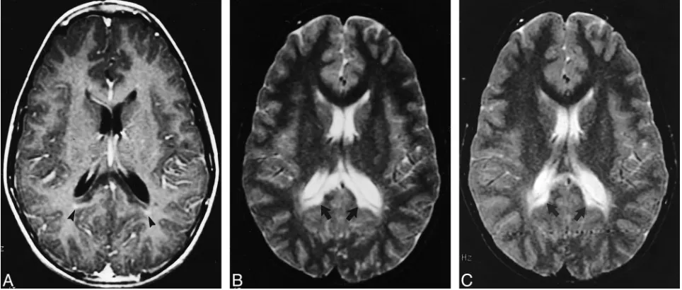 FIG 3.Images of a 12-year-old male patient with X-linked ALD with stable neurologic function.A, Initial contrast-enhanced axial T1-weighted MR image (500/20), obtained at the level of the splenium of the corpus callosum, showsminimal linear enhancement outlining the periphery of the zone of demyelination (arrowheads).B, Axial T2-weighted MR image (3000/100), obtained at the level of the splenium of the corpus callosum at the same time as theimage shown in panel A, shows conﬂuent and symetrical white matter hyperintensity limited the splenium of the corpus callosum andboth forceps major (arrows).C, Thirty-month follow-up axial T2-weighted MR image (3000/100), obtained at a level similar to that shown in panel B, shows nointerval change (arrows).