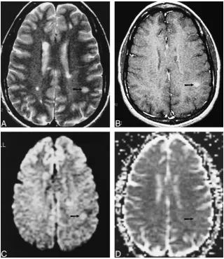 FIG 2.Example of an HEL in a patientwith MS.A–D, Axial T2-weighted image (4000/