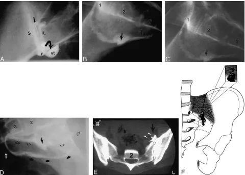 TABLE 1: Observed contrast extravasation patterns from 76 sac-roiliac joints