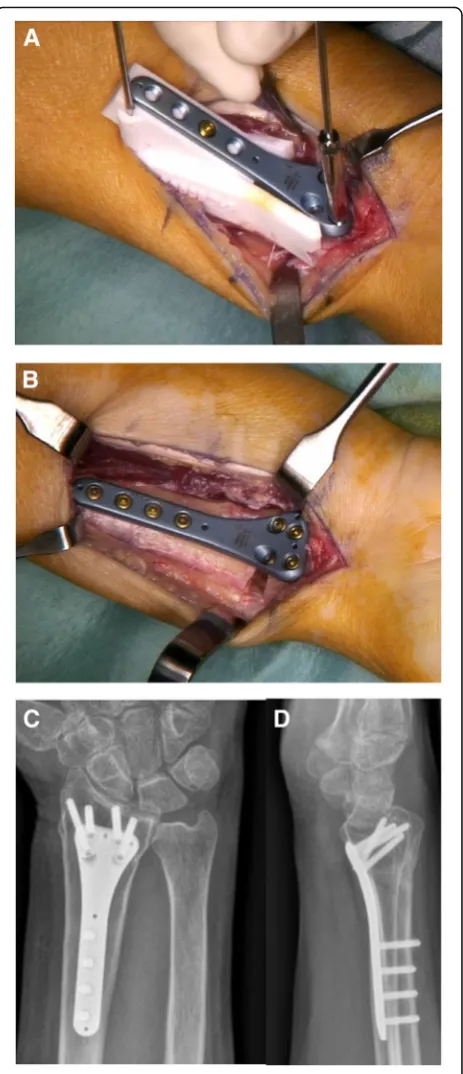 Fig. 2 a Ramp-guide (white) with temporal fixation by K-wires onthe most proximal drilling-hole