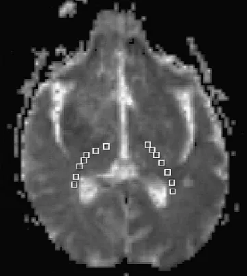 Figure 2. Figure 3 is a sagittal image showing the locations ofthe axial sections.The ﬁber tracts superior to the spinal cord on the right (ip-