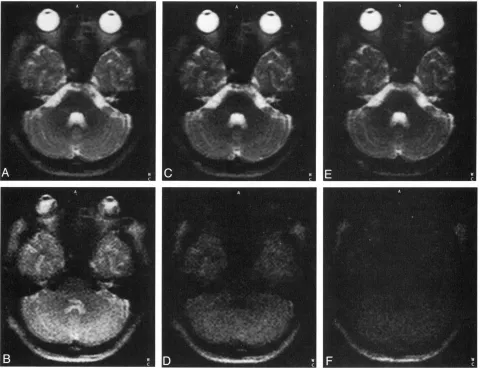 FIG 3.Averaging of several single-shot images allows improved SNR and/or smaller FOV. Averaged transverse sections with a thick-ness of 10 mm and an FOV of 175 � 350 mm (matrix 96 � 256) from eight single-shot scans in a 28-year-old volunteer