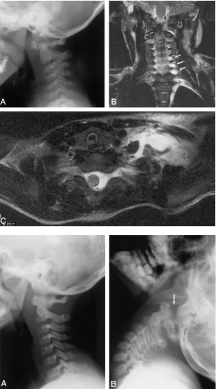FIG 4.Nonfatally injured, unrestrainedforward-facing child passenger.A, Lateral cervical spine radiograph