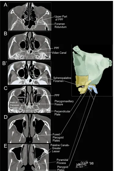 FIG 8.Axial CT scans show osseous anatomy of the structures marginating the PPF, obtained superiorly to inferiorly, referenced toFigure 5C.A, The foramen rotundum is shown communicating with the upper part of the PPF.B and B�, The same CT scan through the 