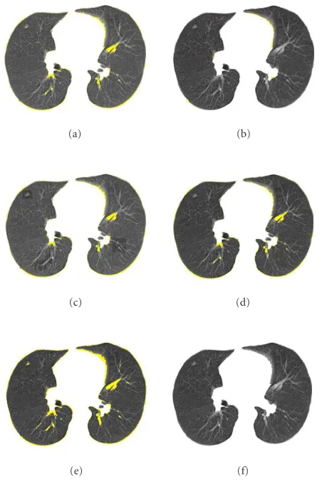 Figure 12: (a) Initial lower-level segmentation; (b) ﬁnal lungregions (the error of 0.89%); (c) lung regions obtained with therandomly chosen higher-level parameters (the error of 1.86%); (d)segmentation by the MRS algorithm with the potential values 0.3an