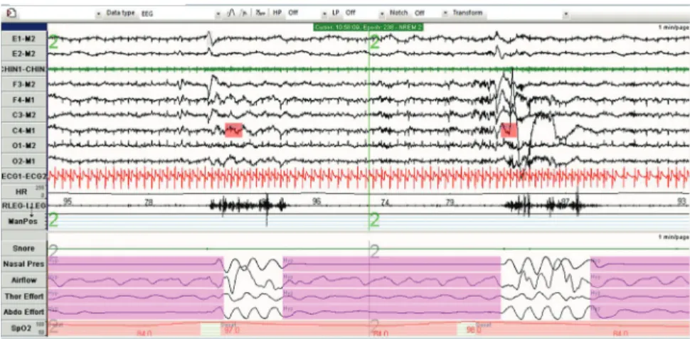 Figure 1. This image is a one-minute epoch of a laboratory-based PSG (Compu- (Compu-medics, Charlotte, NC)