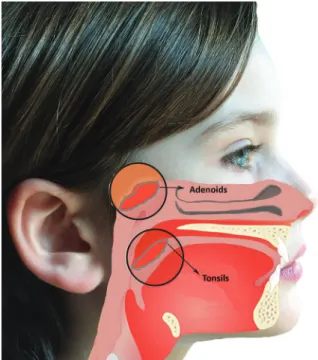 Figure 1. Adenoids and tonsils in normal relationship with nasopharynx.