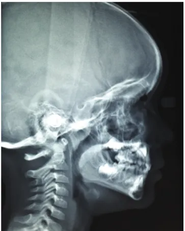 Figure 2. Lateral cephalogram traditionally used for airway evaluation.