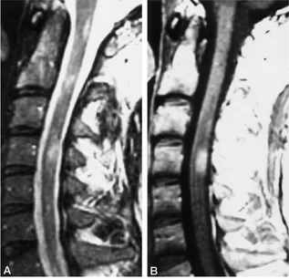 FIG 3.A 20-year-old man with new clin-ical manifestations of myelopathy, sensorylevel at T-12, and EDSS score of 2.0.A, Sagittal T2-weighted image of the