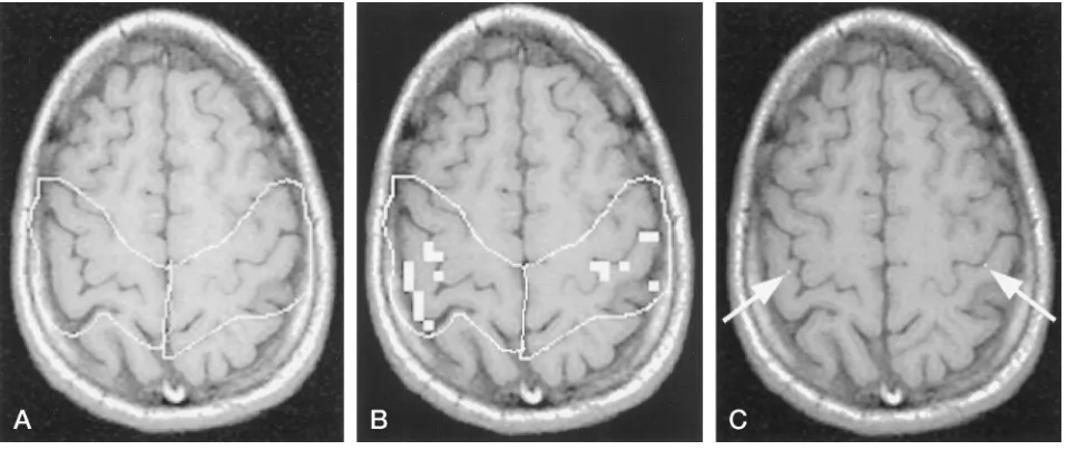 FIG 2.ROIs and centroids.After the ROIs were drawn around the pre- and postcentral gyri using standard neuroanatomic criteria (A), the number of activationpixels within the ROIs was tabulated (B) and the centroids of the activation pixels within the ROIs w
