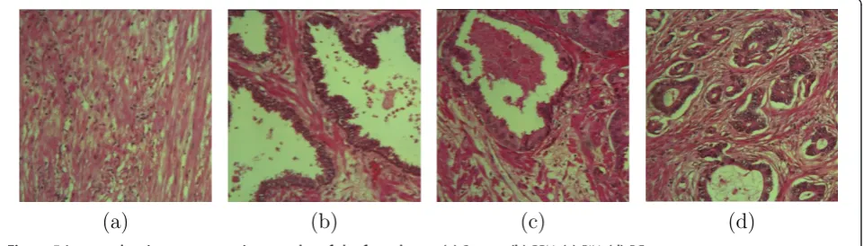 Figure 5 Images showing representative samples of the four classes. (a) Stroma, (b) BPH, (c) PIN, (d) PCa.