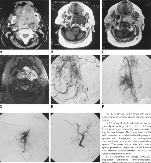 Fig 1. A 55-year-old woman with carci-