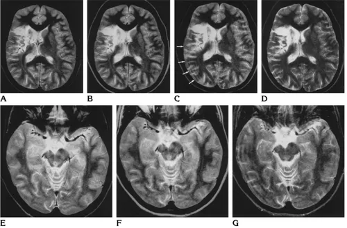 Fig 3. A 32-year-old patient with infarction in the territory of the right middle cerebral artery.AGRASE image (contrast of gray to white matter, however