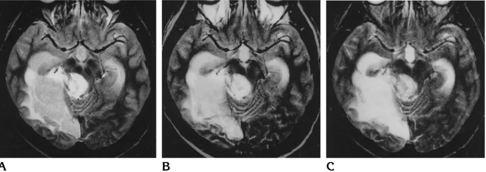 Fig 4. Postoperative control study in 41-year-old patient with astrocytoma (grade III)